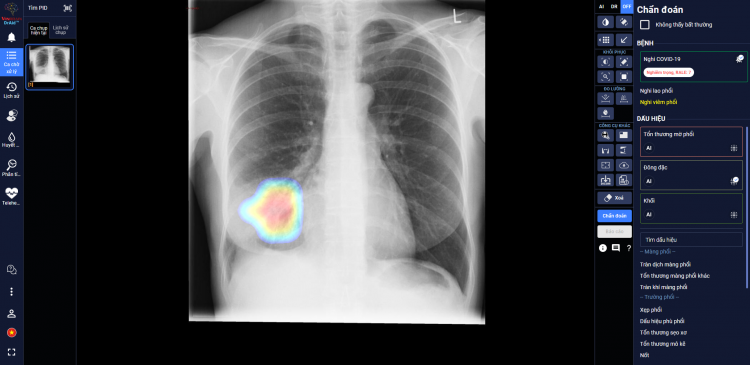 Tin Hot: Trí tuệ nhân tạo AI giúp chuẩn đoán ung thư phổi sớm một năm